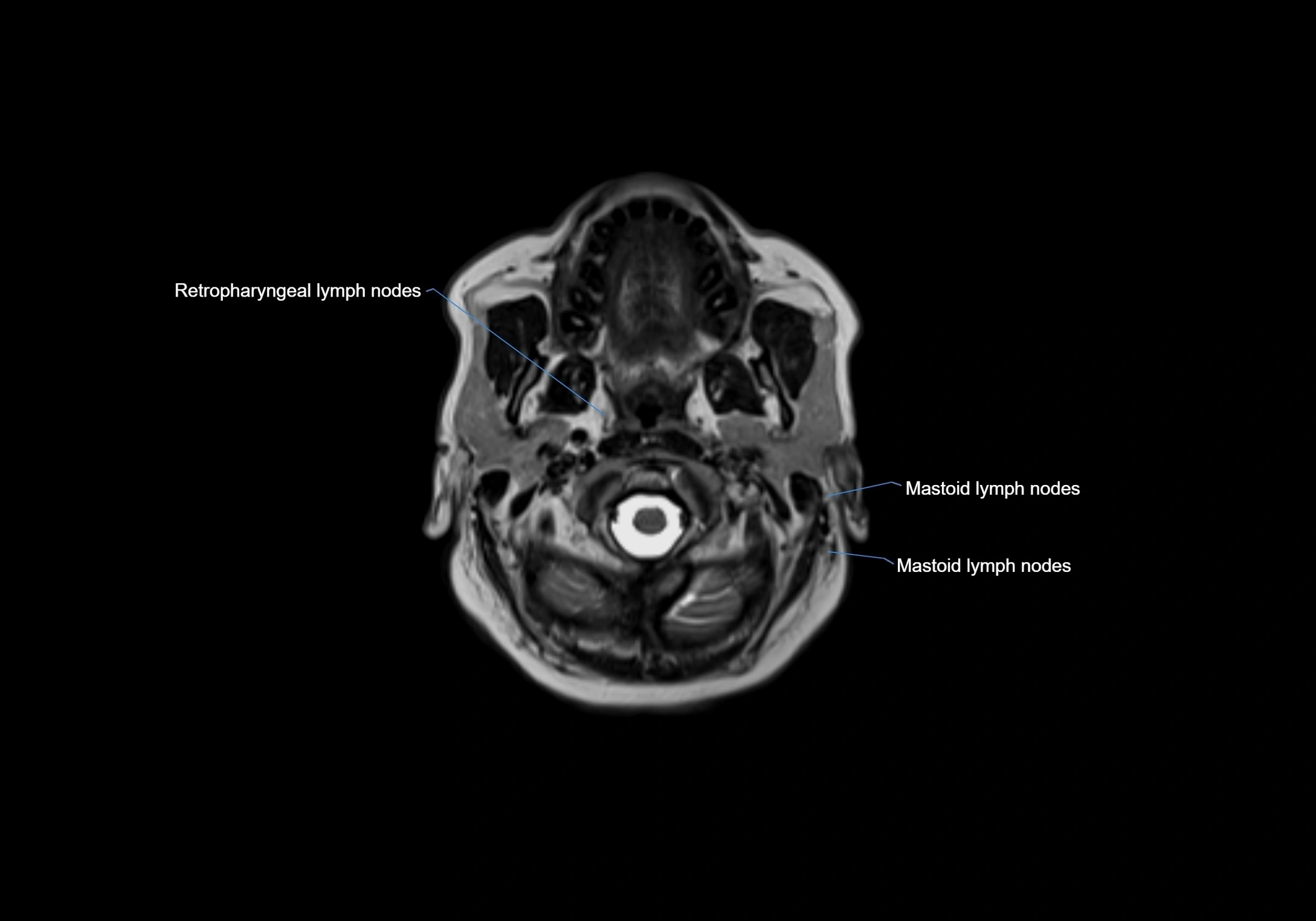 Neck axial  lymph node cross sectional MRI anatomy 3T MRI  image-img-00001-00029.webp